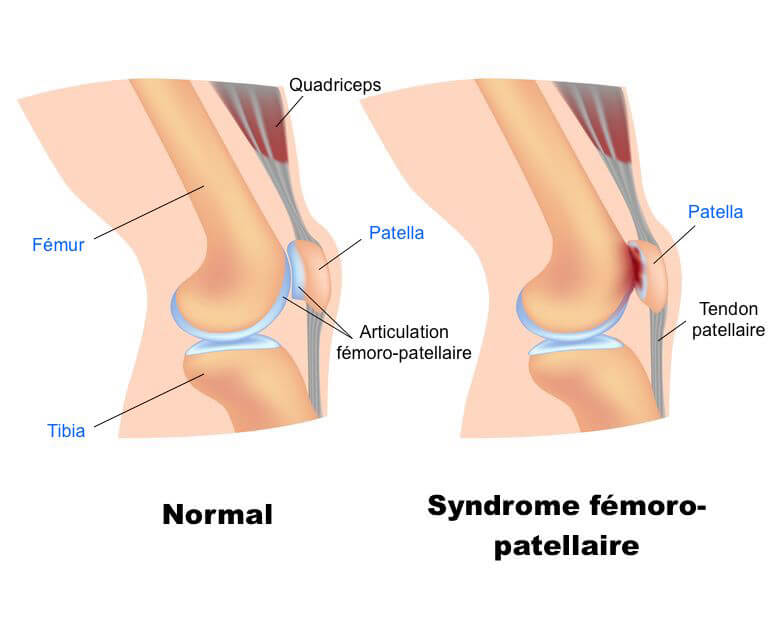 syndrome fémoro patellaire