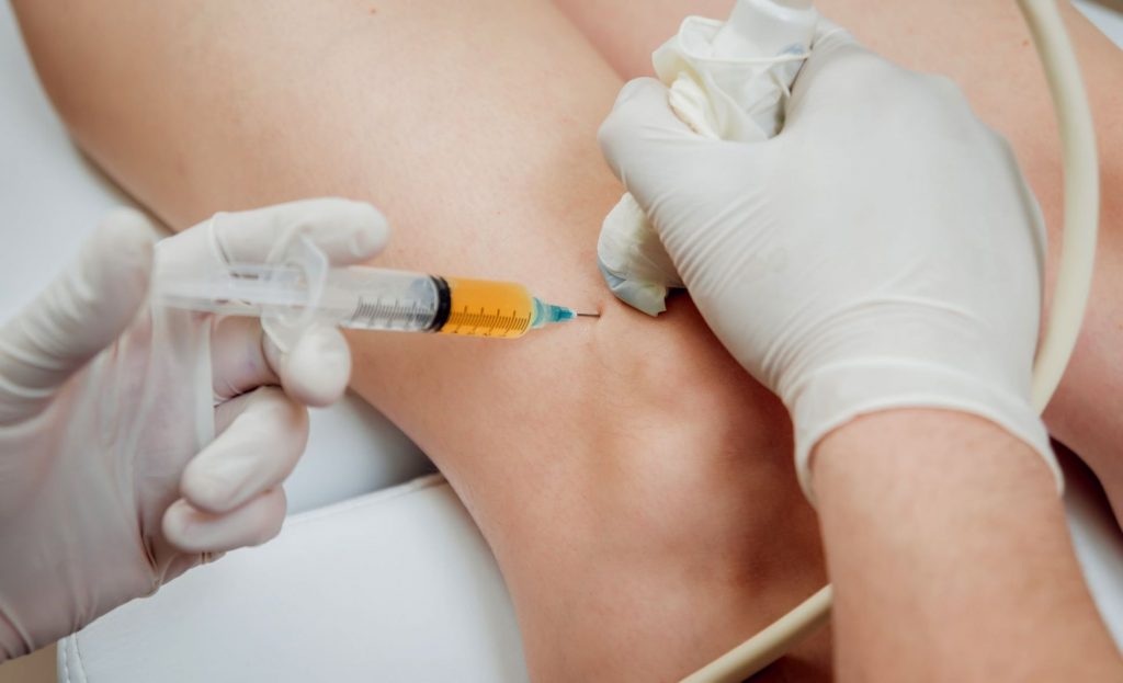 PRP infiltration