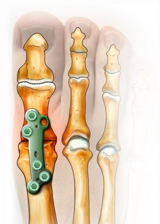 arthrodese plaque