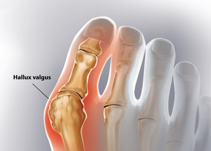 hallux valgus