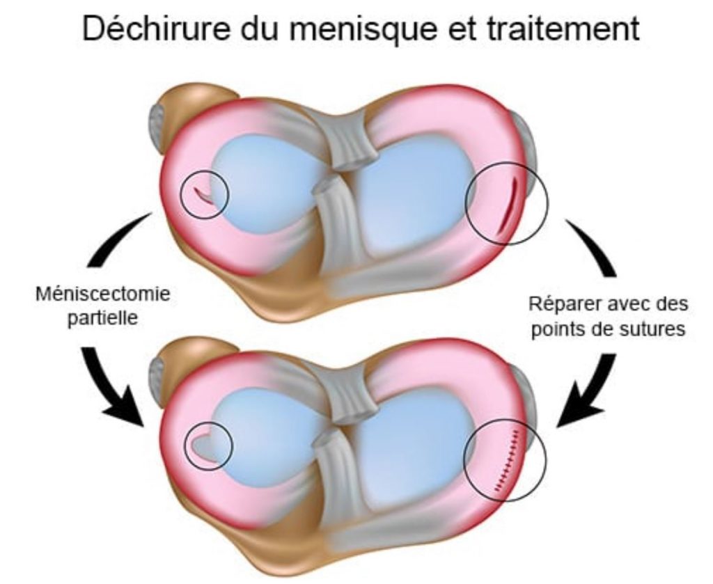 Ménisque