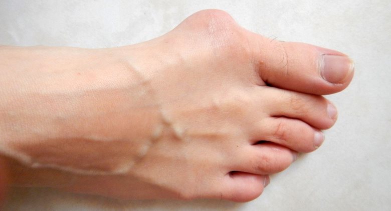 oignon hallux valgus