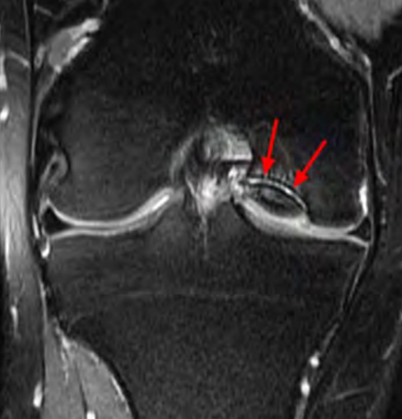 osteochondrite IRM