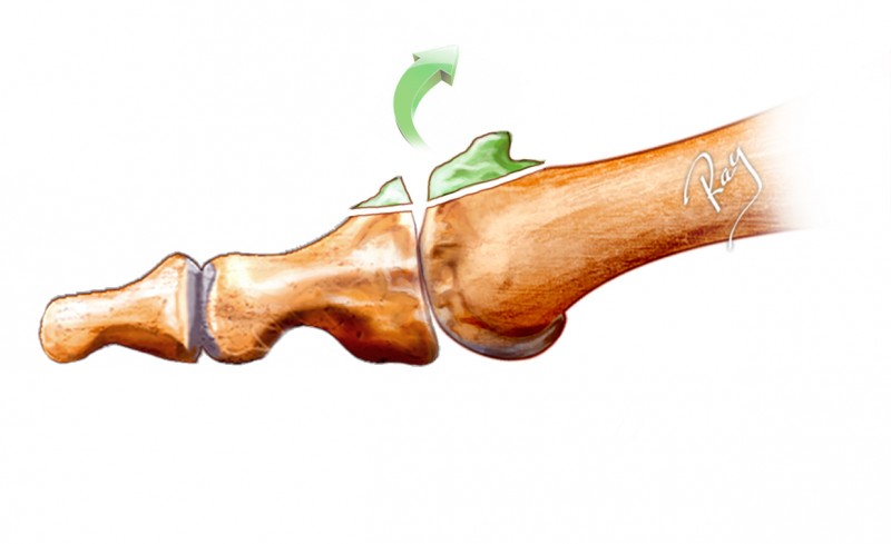 Hallux rigidus