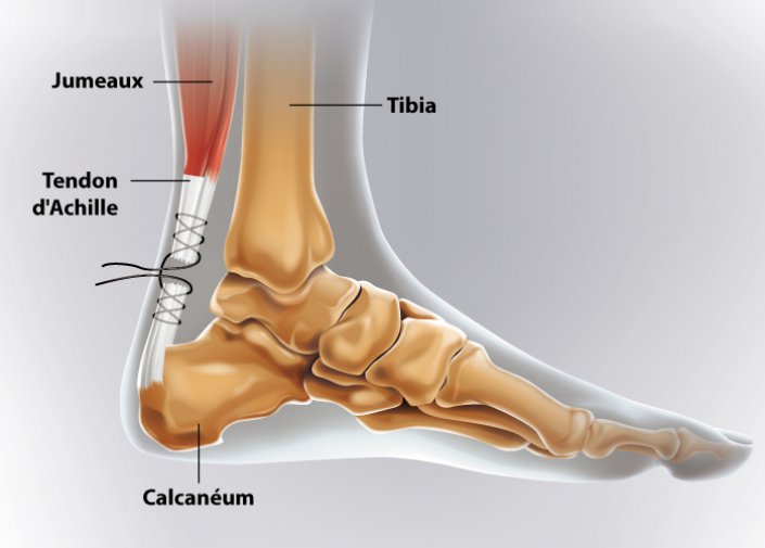 réparation tendon d'Achille