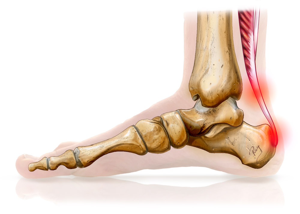 tendinopathie d'achille