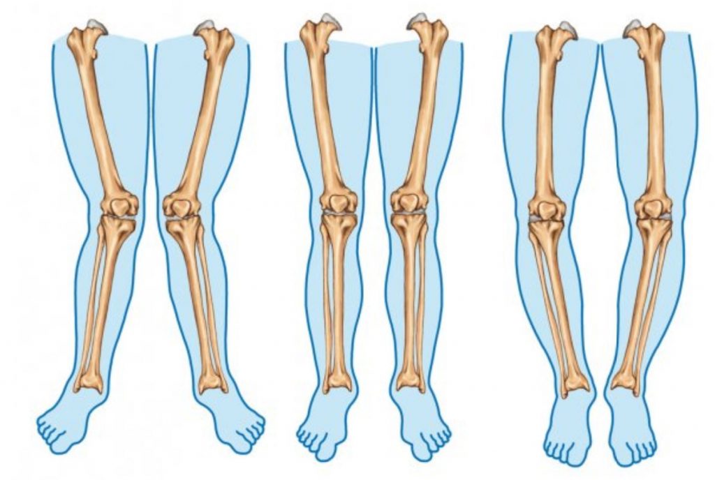 valgus-neutre-varus